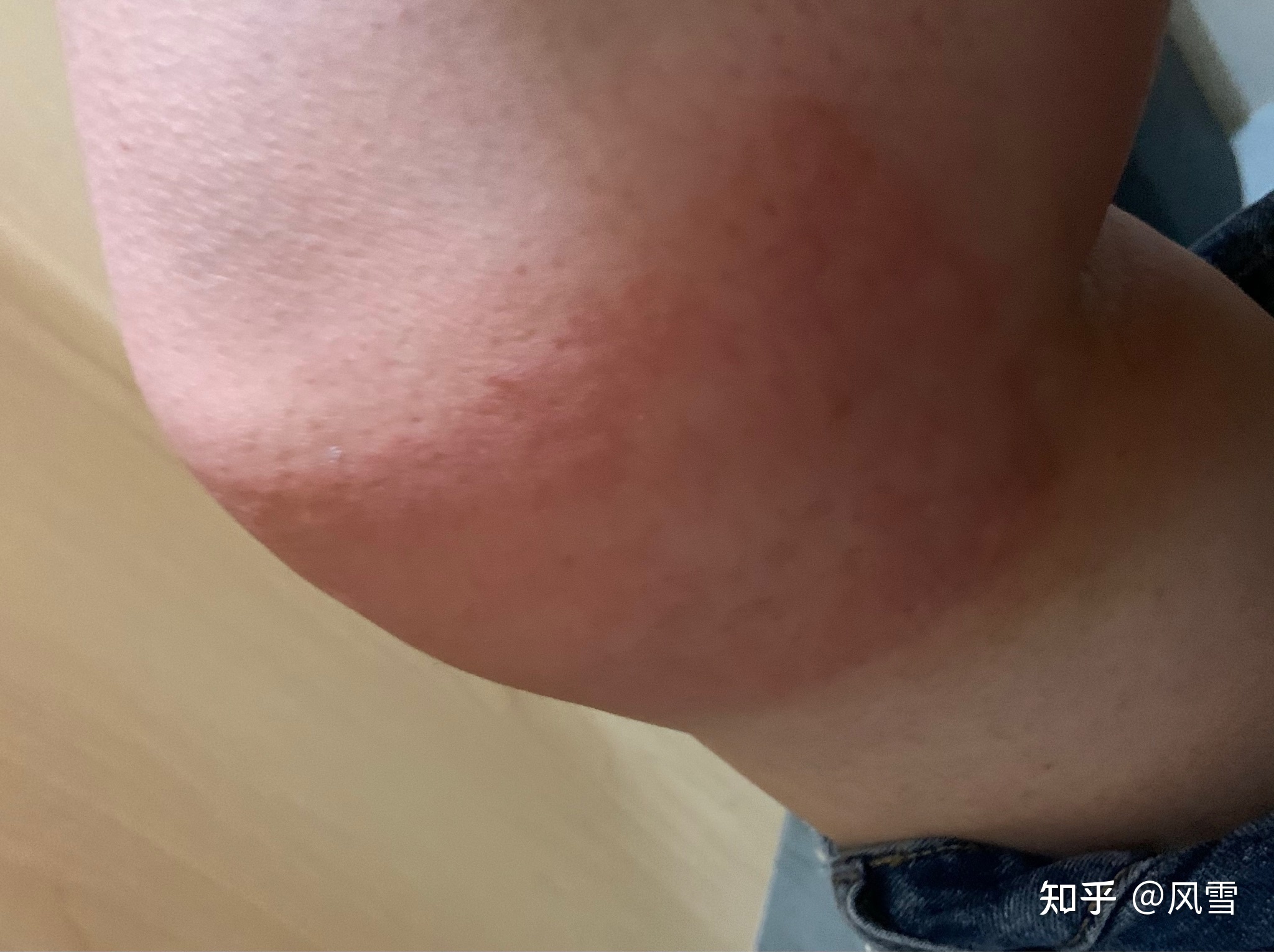 1、貼膏藥過敏癢紅腫怎么辦？